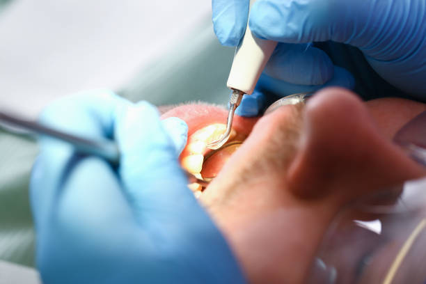 Best Emergency Root Canal Treatment in Wixom, MI